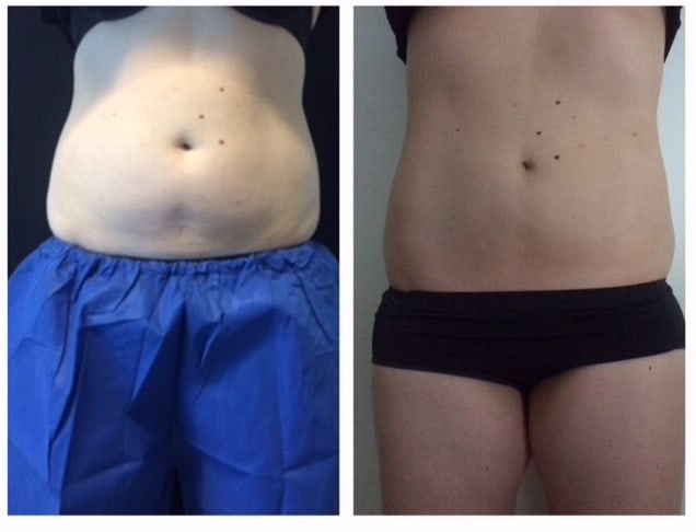 CoolSculpting Brisbane before and after results - About Face Brisbane
