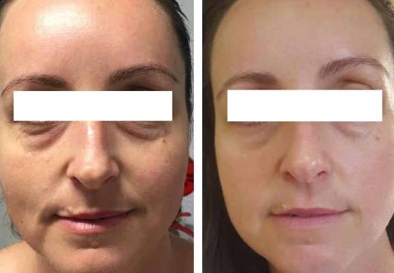 CoolSculpting Brisbane before and after results - About Face Brisbane